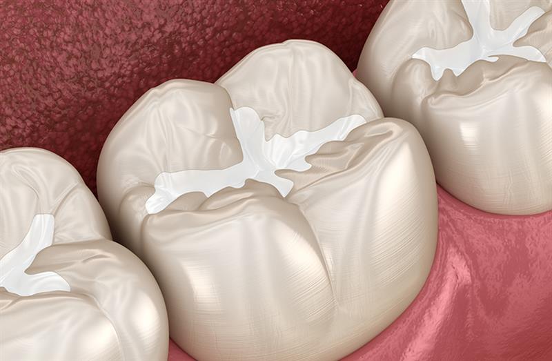 Composite Fillings - Repair and fill cavities